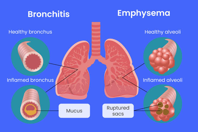 Bronchitis vs. Emphysema in COPD, AI generated