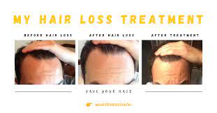 A lot of women and men try chemical products that have side effects or do expensive hair transplants to regrow hair. The Hair Loss Treatment That Reversed My Receding Hairline