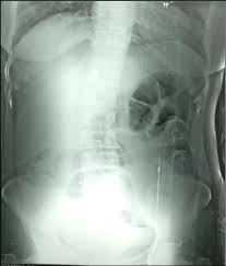 Abdominal X Ray In The Upright Position Showing Dilated Air Filled Download Scientific Diagram
