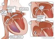 Image result for rashkind balloon atrial septostomy