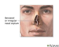 The head …cartilaginous and bony wall, the nasal septum. Septoplasty Series Indications Medlineplus Medical Encyclopedia