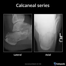 Image result for Calcaneus