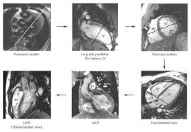 Image result for Cardiac MRI