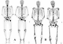 Read about bone cancer prognosis, treatment, symptoms, signs, survival rate, types, metastatic, and stage 4 chondrosarcoma is most commonly found in the bones of the hips and pelvis. Bone Metastasis Cancer Symptoms Life Expectancy Treatment