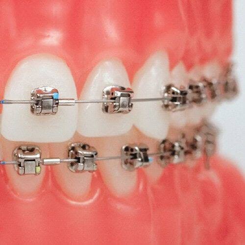 Damon braces product image