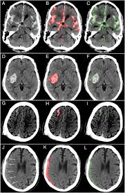 If you or someone else has risk factors for a brain bleed or is demonstrating symptoms of a brain bleed, you need to seek medical attention urgently. Expert Level Detection Of Acute Intracranial Hemorrhage On Head Computed Tomography Using Deep Learning Pnas
