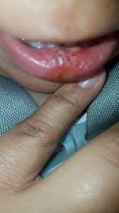 Busted Lip | Babycenter