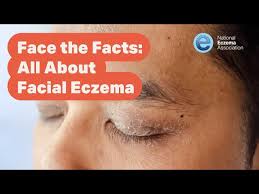 Image result for ekzema face