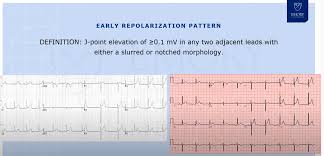 Image result for Early Repolarization