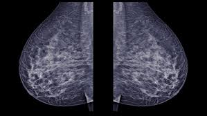 In a normal breast, a mammogram shows normal skin dark grey fat and lighter grey breast tissue. 2d Or 3d Mammograms What S The Best Breast Screening Exam