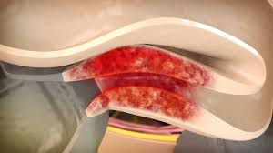 Morbus Crohn Symptome Ernahrung Behandlung Ndr De Ratgeber Gesundheit
