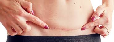I have been a patient of his for over a year. Vancouver Laser Scar Removal Scar Revision Surrey Surgery Injections