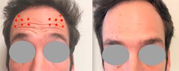 Les injections prennent effet en quelques jours, relâchant et affaiblissant les muscles, atténuant les spasmes. Particularites Des Injections De Toxine Botulique Pour Le Traitement Esthetique Du Visage Chez L Homme Une Mise Au Point De La Litterature Sciencedirect