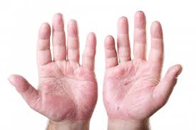 Venele sunt vase de sange daca aveti tromboza venoasa profunda, circulatia sangelui prin vene este partial sau complet blocata de un cheag de sange. Dermatita De Staza Forum Wasatchpremiermovers Com
