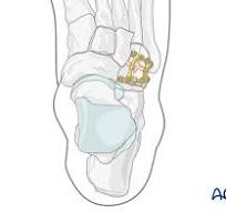 Plate fixation for Multifragmentary cuboid fracture