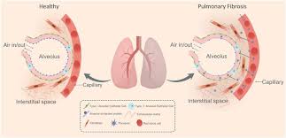 Image result for Pulmonary Intoxicant