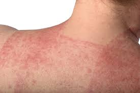 Image result for contact dermatitis