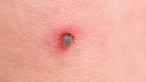Insect Bites Pictures Symptoms And Treatment Health