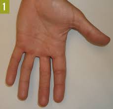 Check spelling or type a new query. Collection Of Conditions Affecting The Hands Consultant360