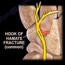 Image result for Hamate Bone