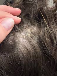 Image result for white scabs on the head in children
