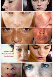 Typing tame kema cho? gives you તમે કેમ છો?. Akakbedaksejuk On Twitter Kenali Jenis Jerawat Jeragat Parut Serta Produk Yang Sesuai Dengan Nya