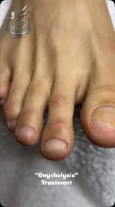 Image result for Onycholysis feet