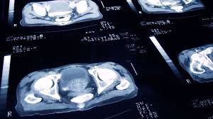Some early prostate cancer signs include: Prostate Cancer Thousands Of Men To Benefit From New Drug Approved For Use On Nhs Uk News Sky News