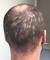 Female Patchy Hair Loss