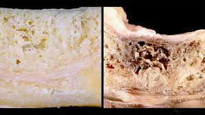 Image result for Alveolitis sicca)