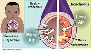 Check spelling or type a new query. Bronchiolitis For Parents Nemours Kidshealth