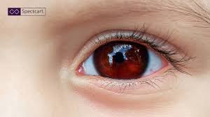 Image result for Hyphema