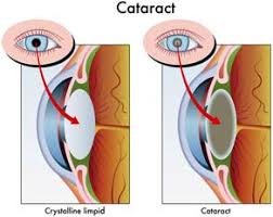 So, yes, traditional cataract surgery with standard lens replacement is covered by medicare and most insurances. This Senior S Experience With Cataract Surgery Eldercare Home Health Inc