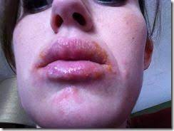 Allergic Reaction On The Lips Anyone Else Out There Have Crazy Allergies Or Reactions How About To Allergy Reactions Lips Reactions