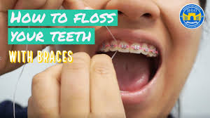When flossing with braces, it is important to remember that there are many metal pieces and corners to floss. How To Floss With Braces 3 Flossing Tips Youtube