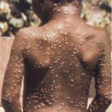 Use templates, graphics, and stock photos and. Clinical Picture Of Monkeypox Rash Image Credit Cdc Download Scientific Diagram