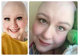 Visible Signs of Multiple Sclerosis Fatigue