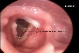 Image result for Acute Laryngitis