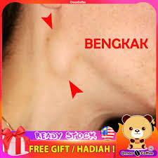Danel juga memberitahu, bahawa nenek lili memang pandai memasak dan masakannya sungguh sedap. Buy Bengkak Leher Wanita Breast Lump Fibrocystic Jerawat Ketuat Pimples Ubat Obat Detox Seetracker Malaysia