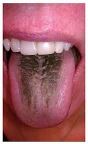 Image result for black hairy tongue symptoms