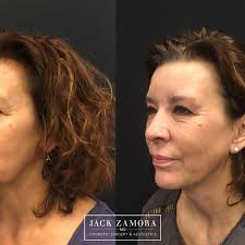 Denver women to show off inventive new facelifts