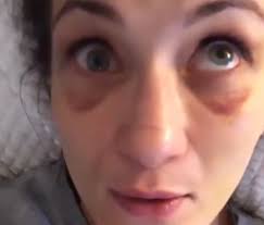 Zwycięstwo kowalkiewicz przez niejednogłośną decyzję. Dramatyczne Wideo Karoliny Kowalkiewicz Jej Oko Zapadlo Sie I Nie Rusza Sie Super Express