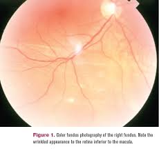 This is often caused by shrinkage of the gel (the vitreous) inside the back of the eye, which is a normal part of ageing. When A Retinal Detachment Isn T A Retinal Detachment