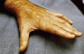 Cubital Tunnel Syndrome Hand Orthobullets