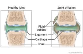 Dictionnaires de référence, étymologie, phonétique, citations littéraires, synonymes et antonymes de définitions du mot effusion. Learning About Joint Effusion