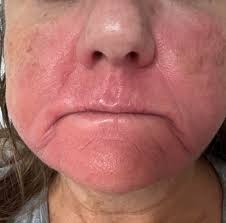 Hello Golpa Family. Today is day 10 with my new smile...Everything is still  progressing so well and I am in awe of Dr. Fadi, Dr. Golpa and the Entire  Tysons Corner staff.