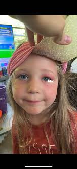 Tongue and lip revision for older children?