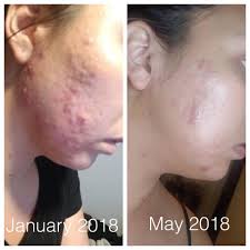 Super Acne Fighter Organic Acne Treatment Acne Essential Oils Butter Me Up Organics
