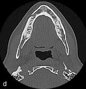 (b) pacd opacifies forming aradiographic ''target lesion'' in later stages of the disease. Osseous Cemento Osseous Dysplasia Of The Jaws Clinical And Radiographic Analysis Jcda