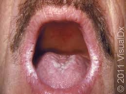 Image result for Oral thrush roof of mouth